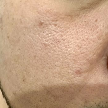 Yüksek Fiyatlı Serumun Aksine Cilt Sorunlarını Artırması Ve İade Talebi