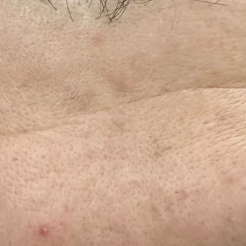 Yüksek Fiyatlı Serumun Aksine Cilt Sorunlarını Artırması Ve İade Talebi