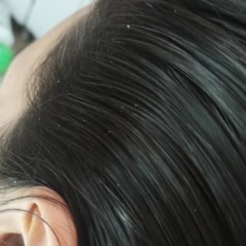 İzmir Özel Can Hastanesi Çiğli Şubesinde Hijyen Skandalı: Fizik Tedavi Havlularında Bitlenme