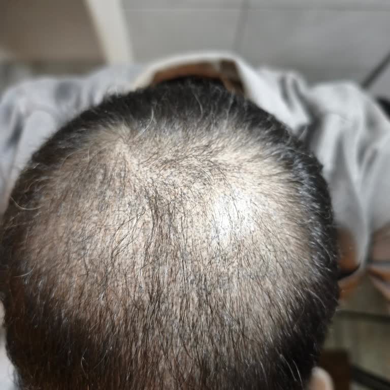 Saç Simülasyonunda Kalıcılık Vaadi Aşan Erken Solma Ve Ücret İadesi Talebi