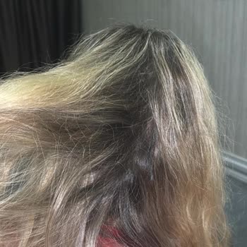 Saç Yanması Ve Kafa Taşı Ağrısı Nedeniyle 6200 TL Ücretin İadesi Talebi