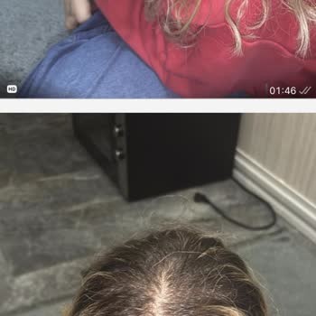 Saç Yanması Ve Kafa Taşı Ağrısı Nedeniyle 6200 TL Ücretin İadesi Talebi