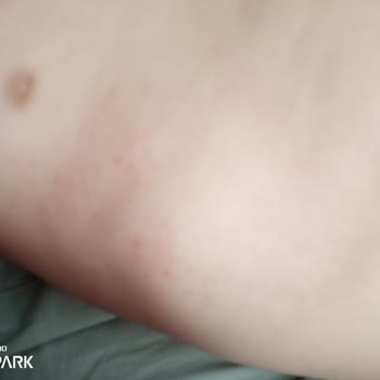 Mustela Stelatopia Ürünü Nedeniyle Bebekte Şiddetli Alerjik Reaksiyon