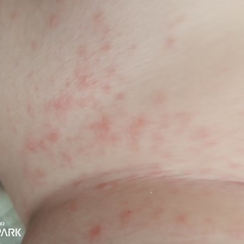 Mustela Stelatopia Ürünü Nedeniyle Bebekte Şiddetli Alerjik Reaksiyon