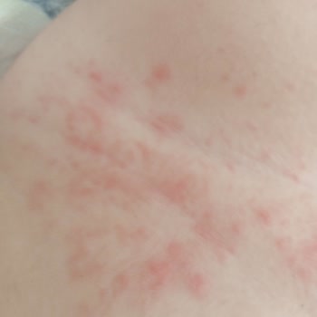 Mustela Stelatopia Ürünü Nedeniyle Bebekte Şiddetli Alerjik Reaksiyon