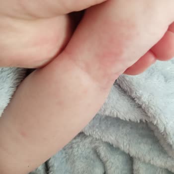 Mustela Stelatopia Ürünü Nedeniyle Bebekte Şiddetli Alerjik Reaksiyon