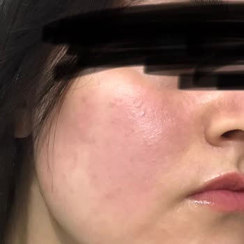 Mclub Ciddi Cilt Problemlerine Yol Açtı