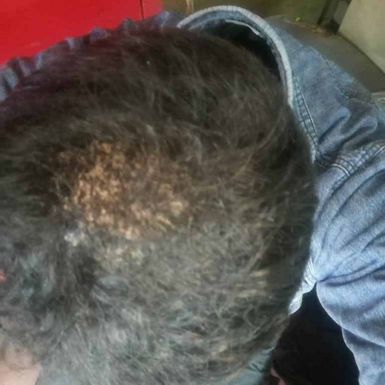 Batçı Şampuan Ve Saç Kapatıcıda Deri Yanması Ve Siyah Lekeler, Cevapsız Şikayet