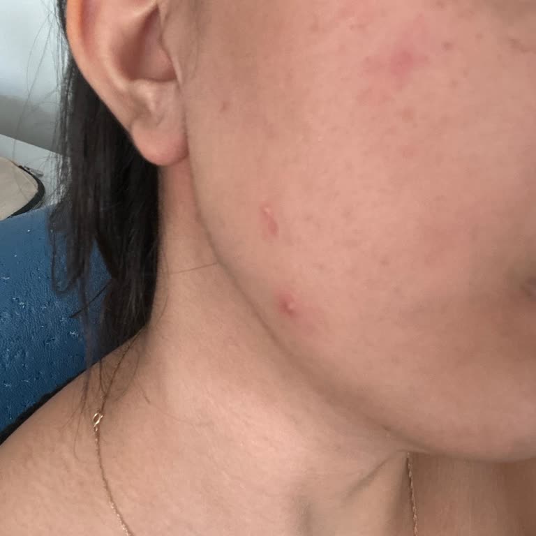 La Roche Posay Effaclar Duo+ Kullanımı Sonrası Şiddetli Sivilceler Ve Tam İade Talebi