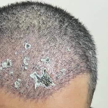 İzinsiz Ve Hatalı Saç Ekimi Sonrası Ciddi Sağlık Sorunları Ve Mağduriyet