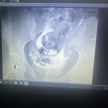 Şanmed Hastanesinde Hsg İşleminde Bilgi Eksikliği Ve Tekrarlanan Anestezi Mağduru