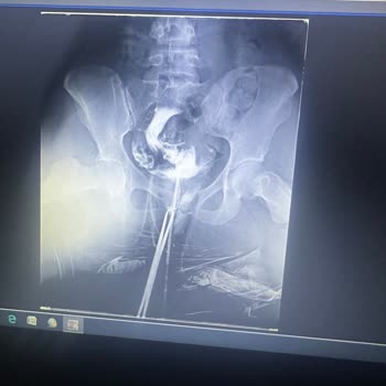 Şanmed Hastanesinde Hsg İşleminde Bilgi Eksikliği Ve Tekrarlanan Anestezi Mağduru