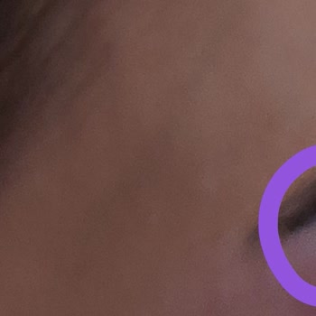 Kalın Kaş Talebim İhmal Edildi Ve İşlem Sonrası Kaşlar İnceltilip Ciltte Kanama Oluştu