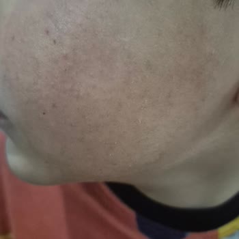 Mustela Stelatopia+ Kremi Çocuğumun Yanağında Kabarma Ve Cilt Reaksiyonu