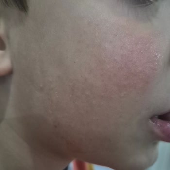Mustela Stelatopia+ Kremi Çocuğumun Yanağında Kabarma Ve Cilt Reaksiyonu