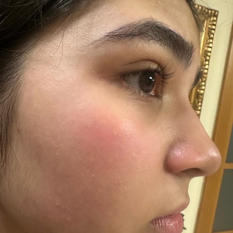 Yves Rocher Pure Algue Yüz Yıkama Jelinde Alerjik Reaksiyon Ve İade Talebi