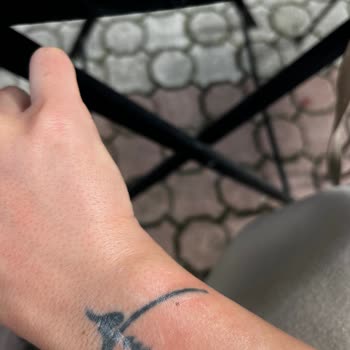 Kardelen Lazer Uygulamasında Yanma Ve Dövme Hasarı