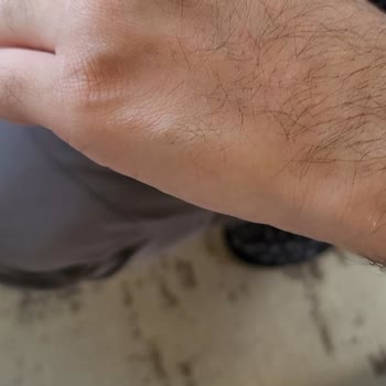 Çalışmayan Epilatör Ve İade Talebinin Reddedilmesi