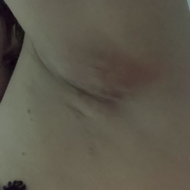 İsana Deodorant Kremi Kullanımı Sonrası Şiddetli Cilt Reaksiyonu