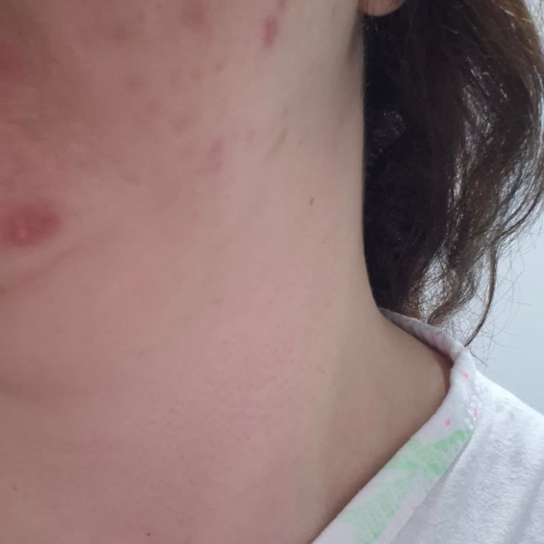 Phlab Akne Sabunu Kullanımından Sonra Artan Akne Ve Kızarıklık İade Talebi