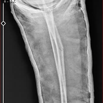 Çocuğumun Kolunda Yanlış Tedavi Nedeniyle Deformasyon Ve Ameliyat Talebi
