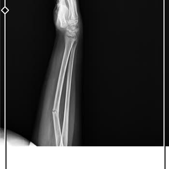 Çocuğumun Kolunda Yanlış Tedavi Nedeniyle Deformasyon Ve Ameliyat Talebi