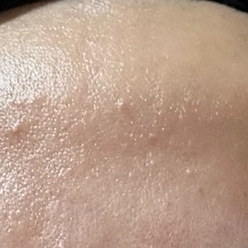 Enpa Dermokozmetik Anthelios Uvmune 400 Güneş Kremi Kullanımından Sonra Ciltte Pütürlenme