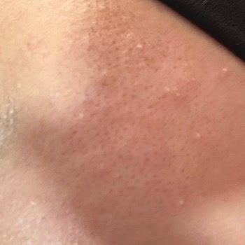 Enpa Dermokozmetik Anthelios Uvmune 400 Güneş Kremi Kullanımından Sonra Ciltte Pütürlenme