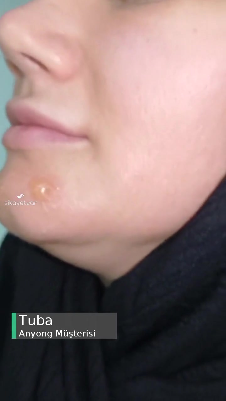 Anyong Vitamin C Antioxidant Serum Etkisi videonun kapak resmi