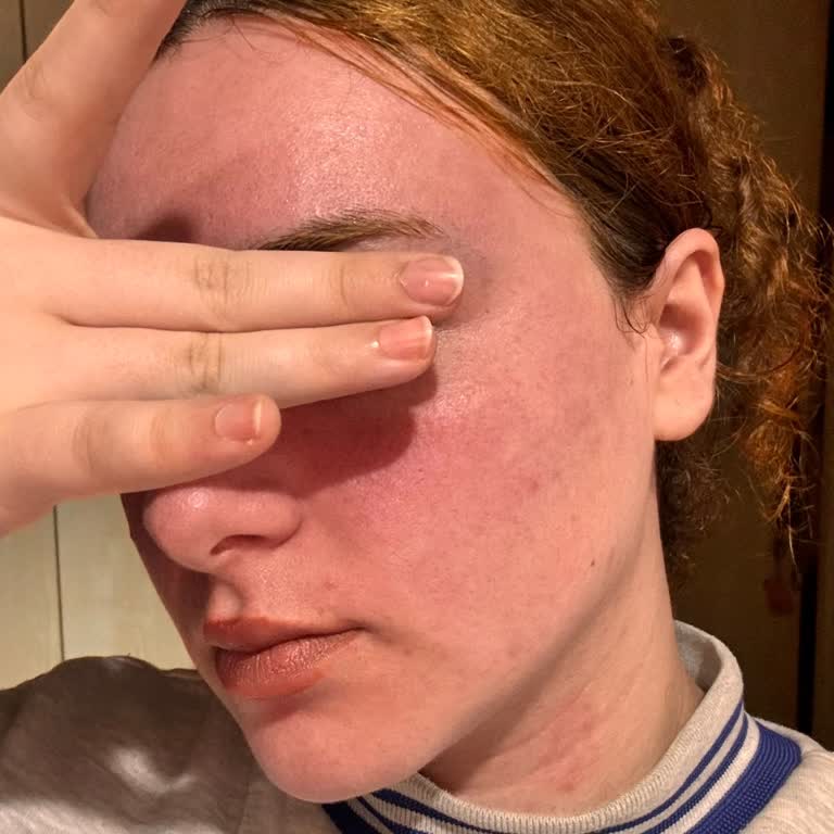 Yves Rocher Pure Menthe Yüz Temizleme Jeli Kullanımında Şiddetli Yanma Ve Kızarıklık