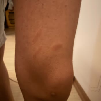 Epilady Kişisel Bakım Salonu Yaşanan Ağır Yanıklar Ve Kalıcı İzler İçin Tazminat Talebi