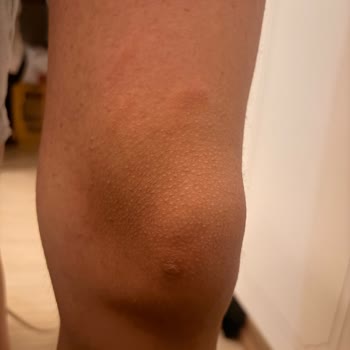 Epilady Kişisel Bakım Salonu Yaşanan Ağır Yanıklar Ve Kalıcı İzler İçin Tazminat Talebi