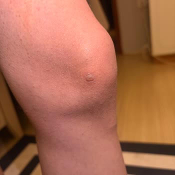 Epilady Kişisel Bakım Salonu Yaşanan Ağır Yanıklar Ve Kalıcı İzler İçin Tazminat Talebi