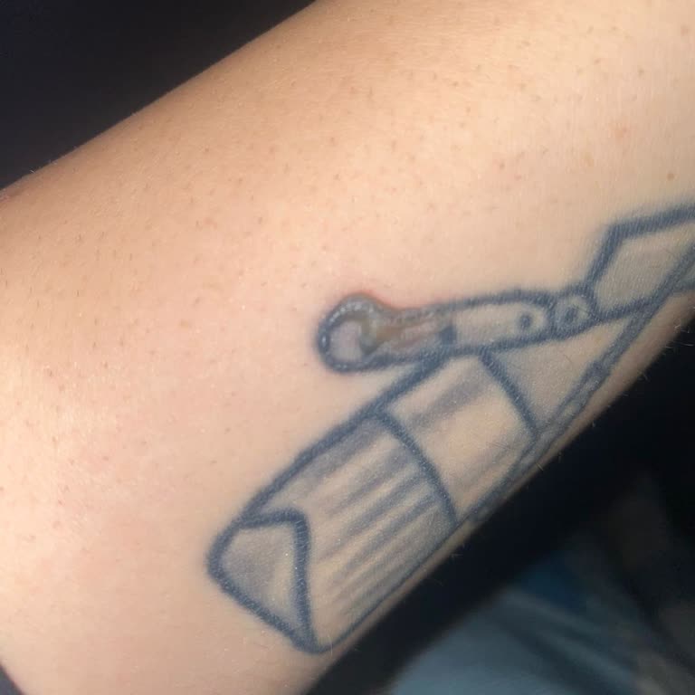 Vaat Edilen Lazer Epilasyon Sonuç Vermedi Ve Dövme Yanığı Oluştu