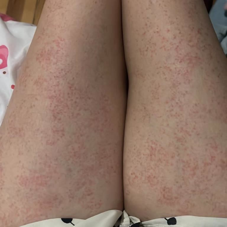 Yanma Ve Yanık İzleri Veren Lazer Epilasyon Cihazının İadesi Talebi