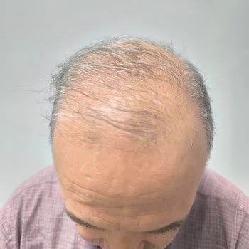 Garanti Edilen Saç Mezoterapisi Sonuç Vermedi, 53.500 TL İadesi Talebi