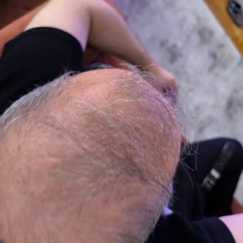 Garanti Edilen Saç Mezoterapisi Sonuç Vermedi, 53.500 TL İadesi Talebi