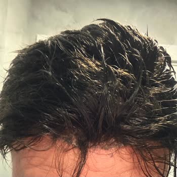 Yüksek Ücretli Saç Protezinde Kısa Sürede Bozulma Ve Değişim Reddi