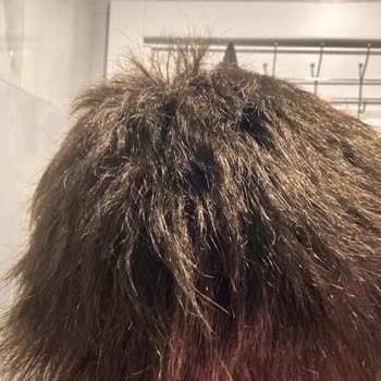 Yüksek Ücretli Saç Protezinde Kısa Sürede Bozulma Ve Değişim Reddi