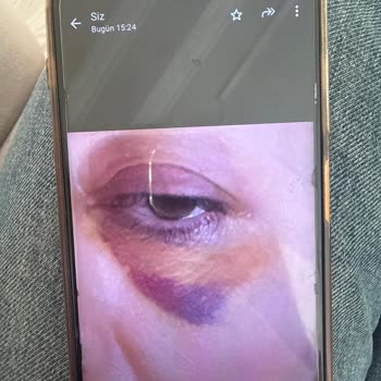 Linemed Ankara Göz Altı Dolgusu Sonrası Sürekli Şişlik Ve Sorumluluk Reddi