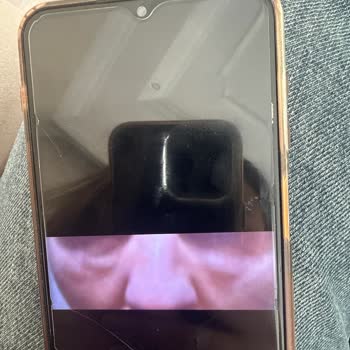 Linemed Ankara Göz Altı Dolgusu Sonrası Sürekli Şişlik Ve Sorumluluk Reddi