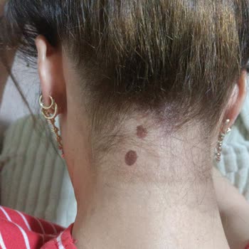 Filiz Yaman Kuaför Güzellik Salonu Cildimde Yanık Oluştu