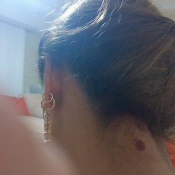 Filiz Yaman Kuaför Güzellik Salonu Cildimde Yanık Oluştu