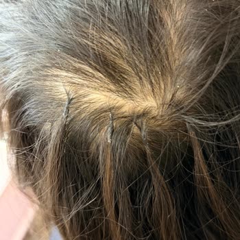 45 Bin TL Ücretli Kaynak Saç İşlemi İçin Tam İade Talebi