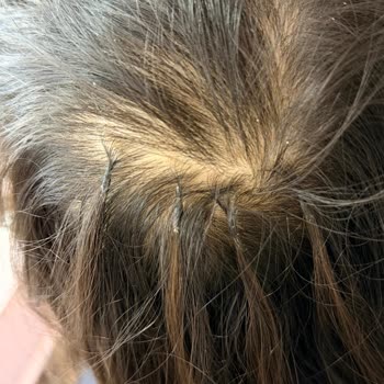 45 Bin TL Ücretli Kaynak Saç İşlemi İçin Tam İade Talebi