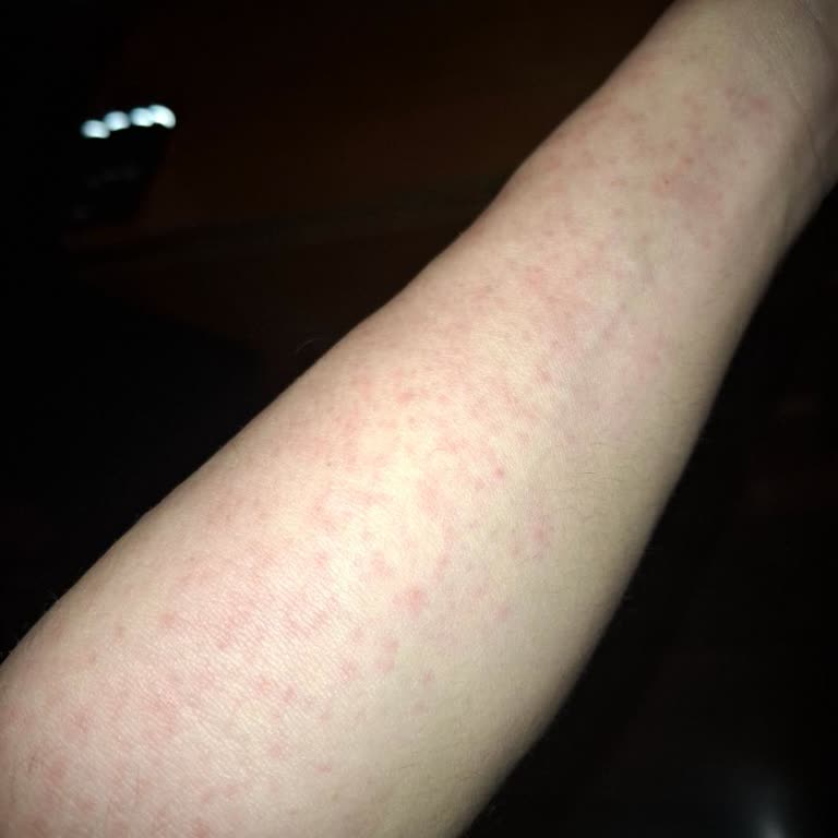 Sesu Hassas Cilt Ağda Bandı Kullanımında Şiddetli Kızarıklık Ve Kaşıntı