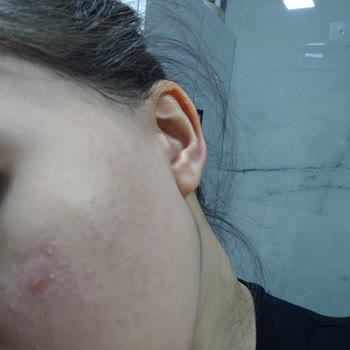 Tiger Grass Tonu Cilt Şişmesine Ve Alerjik Reaksiyona Yol Açtı