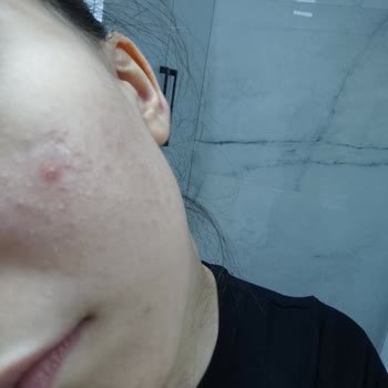 Tiger Grass Tonu Cilt Şişmesine Ve Alerjik Reaksiyona Yol Açtı