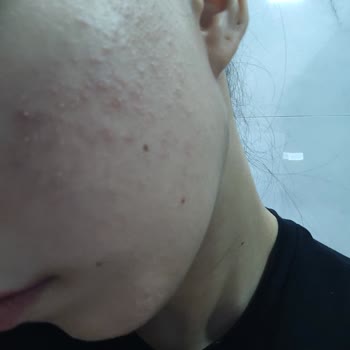 Tiger Grass Tonu Cilt Şişmesine Ve Alerjik Reaksiyona Yol Açtı