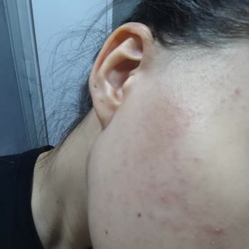 Tiger Grass Tonu Cilt Şişmesine Ve Alerjik Reaksiyona Yol Açtı